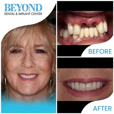 All-On-4® Dental Implants in DFW Area
