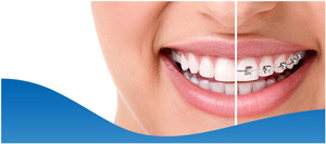 Invisalign vs Braces Near Me in Los Altos, CA Invisalign vs Braces Near Me in Los Altos, CA