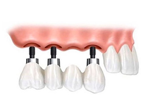 Implant Bridges at ABC Dental Clinic & Implant Center in Los Altos, CA Implant Bridges at ABC Dental Clinic & Implant Center in Los Altos, CA