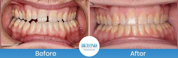 Orthodontics Smile Gallery Near Me in Los Altos, CA