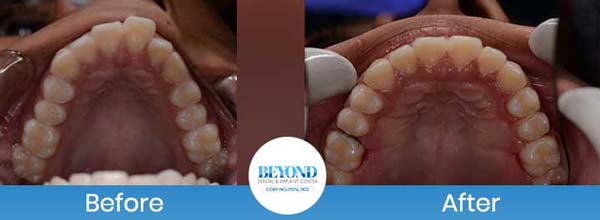 Orthodontics Smile Gallery Near Me in Los Altos, CA