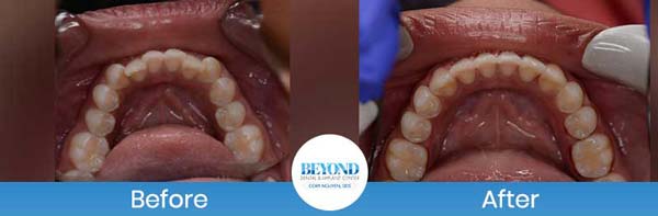 Orthodontics Smile Gallery Near Me in Los Altos, CA