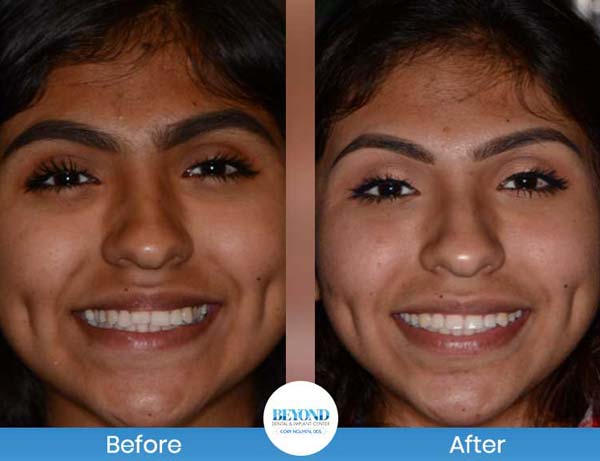 Orthodontics Smile Gallery Near Me in Los Altos, CA