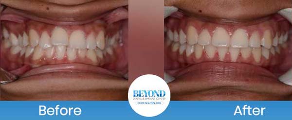 Orthodontics Smile Gallery Near Me in Los Altos, CA