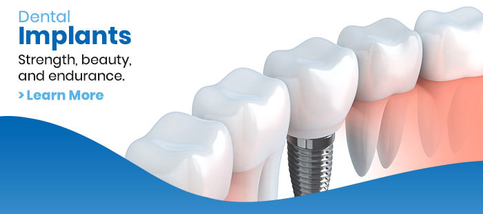 Dental Implant Services in Los Altos, CA Dental Implant Services in Los Altos, CA