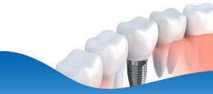 Top Dentist for Dental Implants Near Me in Los Altos, CA Top Dentist for Dental Implants Near Me in Los Altos, CA