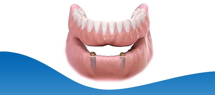 What Are the Best Materials for Dental Implants Near Me in Los Altos, CA What Are the Best Materials for Dental Implants Near Me in Los Altos, CA