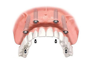 Implant Hybrid Prosthesis (Upper and Lower Jaw) at ABC Dental Clinic & Implant Center in Los Altos, CA Implant Hybrid Prosthesis (Upper and Lower Jaw) at ABC Dental Clinic & Implant Center in Los Altos, CA