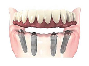 Implant Hybrid Prosthesis (Upper and Lower Jaw) at ABC Dental Clinic & Implant Center in Los Altos, CA Implant Hybrid Prosthesis (Upper and Lower Jaw) at ABC Dental Clinic & Implant Center in Los Altos, CA