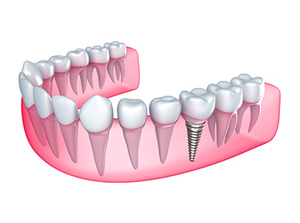 Single Tooth Implant at ABC Dental Clinic & Implant Center in Los Altos, CA Single Tooth Implant at ABC Dental Clinic & Implant Center in Los Altos, CA