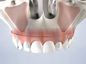 Pterygoid and Zygomatic Implants at ABC Dental Clinic & Implant Center in Los Altos, CA Pterygoid and Zygomatic Implants at ABC Dental Clinic & Implant Center in Los Altos, CA
