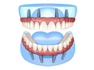 All-On-4® Dental Implants at ABC Dental Clinic & Implant Center in Los Altos, CA All-On-4 Dental Implants at ABC Dental Clinic & Implant Center in Los Altos, CA