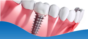 Board-Certified Dental Implant Dentist Near Me in Los Altos, CA Board-Certified Dental Implant Dentist Near Me in Los Altos, CA
