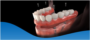 Dental Implants Vs Dentures in Los Altos, CA Dental Implants Vs Dentures in Los Altos, CA