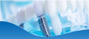 How to Find the Top-Rated Dental Implant Dentist in Los Altos, CA How to Find the Top-Rated Dental Implant Dentist in Los Altos, CA