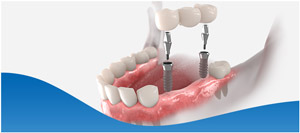 Implant Supported Dentures Near Me in Los Altos, CA