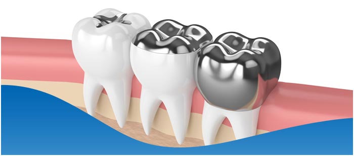 Dental Fillings Vs Dental Crowns Near Me in Los Altos, CA Dental Fillings Vs Dental Crowns Near Me in Los Altos, CA