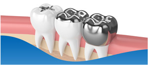 Dental Fillings Vs Dental Crowns Near Me in Los Altos, CA Dental Fillings Vs Dental Crowns Near Me in Los Altos, CA