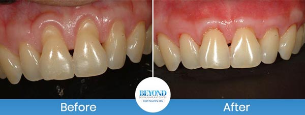 Gum Lift & Gum Graft Before and After Gallery in Los Altos, CA