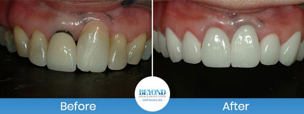 Gum Lift & Gum Graft Before and After Gallery in Los Altos, CA