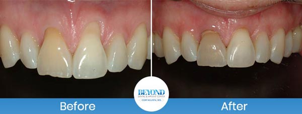 Gum Lift & Gum Graft Before and After Gallery in Los Altos, CA
