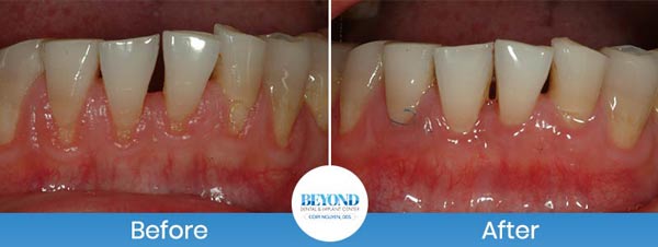 Gum Lift & Gum Graft Before and After Gallery in Los Altos, CA