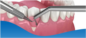 Gum Graft Treatment Specialist Near Me in Los Altos, CA Gum Graft Treatment Specialist Near Me in Los Altos, CA