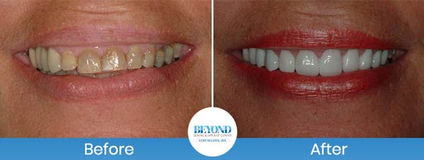 Gum Lift & Gum Graft Before and After Gallery in Los Altos, CA