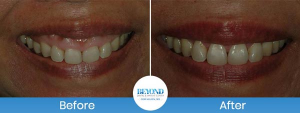 Gum Lift & Gum Graft Before and After Gallery in Los Altos, CA