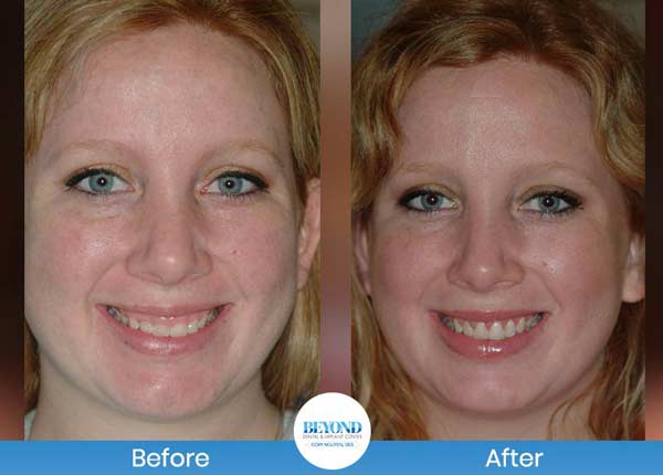 Gum Lift & Gum Graft Before and After Gallery in Los Altos, CA