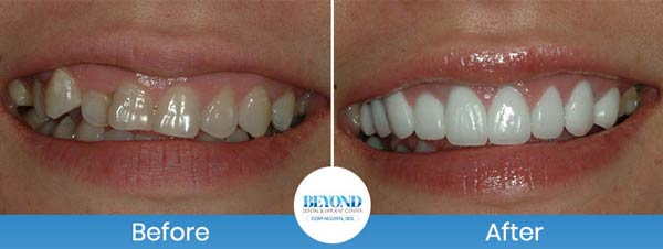 Gum Lift & Gum Graft Before and After Gallery in Los Altos, CA