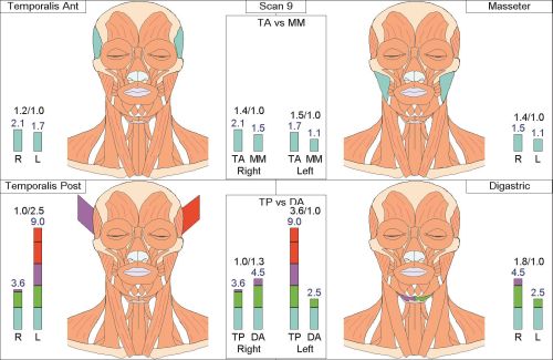 Sign & Symptoms of TMJ Disorder Near Me in Los Altos, CA Sign & Symptoms of TMJ Disorder Near Me in Los Altos, CA