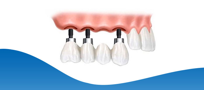 Implant Bridge Procedure Near Me in Los Altos, CA