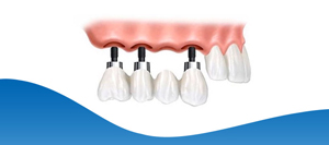 Implant Bridge Procedure Near Me in Los Altos, CA