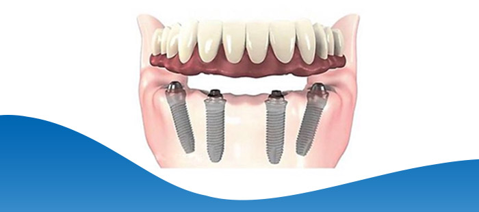 Implant Hybrid Prosthesis for Lower Jaw Near Me in Los Altos, CA Implant Hybrid Prosthesis for Lower Jaw Near Me in Los Altos, CA