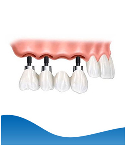 Implant Bridges Near Me in Los Altos, CA