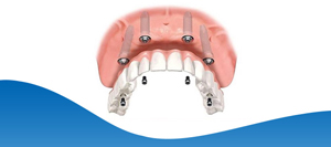 Implant Hybrid Prosthesis (Upper Jaw) in Los Altos, CA Implant Hybrid Prosthesis (Upper Jaw) in Los Altos, CA