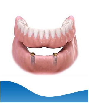 Implant Denture (Lower Jaw) Near Me in Los Altos, CA