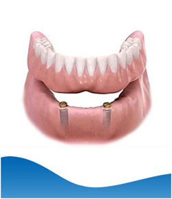 Implant Denture (Lower Jaw) Near Me in Los Altos, CA