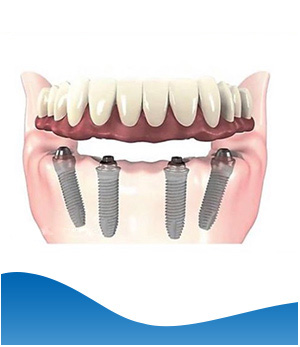 Implant Hybrid Prosthesis (Lower Jaw) Near Me in Los Altos, CA