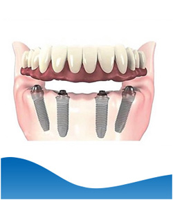 Implant Hybrid Prosthesis (Lower Jaw) Near Me in Los Altos, CA