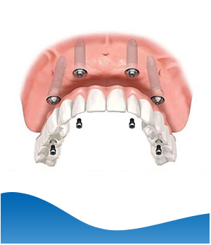 Implant Hybrid Prosthesis (Upper Jaw) Near Me in Los Altos, CA