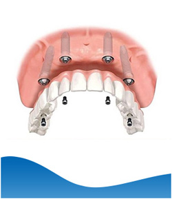 Implant Hybrid Prosthesis (Upper Jaw) Near Me in Los Altos, CA