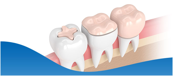Dental Inlays & Onlays Treatment Near Me in Los Altos, CA