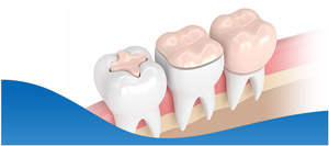 Dental Inlays & Onlays Treatment Near Me in Los Altos, CA