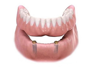 Implant Over Denture (Lower Jaw) at ABC Dental Clinic & Implant Center in Los Altos, CA Implant Over Denture (Lower Jaw) at ABC Dental Clinic & Implant Center in Los Altos, CA