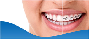 Neuromuscular Orthodontics Near Me in Los Altos, CA Neuromuscular Orthodontics Near Me in Los Altos, CA