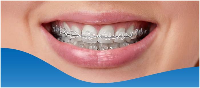 Questions to Ask Your Neuromuscular Orthodontics Near Me in Los Altos, CA Questions to Ask Your Neuromuscular Orthodontics Near Me in Los Altos, CA