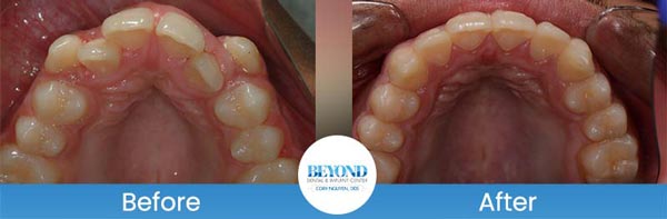 Orthodontics Smile Gallery Near Me in Los Altos, CA