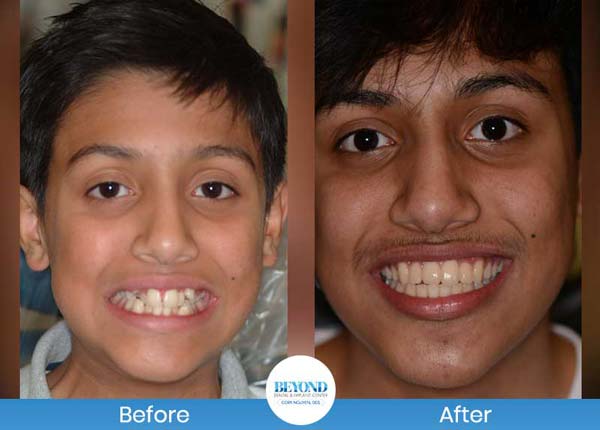 Orthodontics Smile Gallery Near Me in Los Altos, CA